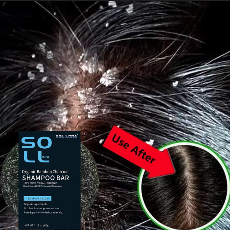 Fast Anti Dandruff Hair Treatm - Hair Care Dandruff 리뷰 및 가격