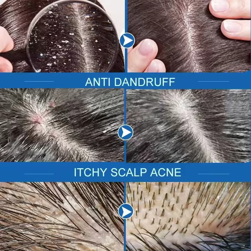 Fast Anti Dandruff Hair Treatm - Hair Care Dandruff 리뷰 및 가격