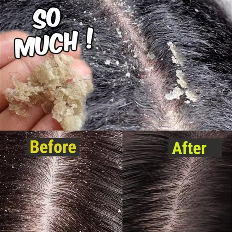 Fast Anti Dandruff Hair Treatm - Hair Care Dandruff 리뷰 및 가격